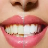 Dicas para clarear os dentes em casa naturalmente