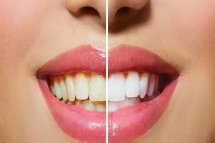 Dicas para clarear os dentes em casa naturalmente